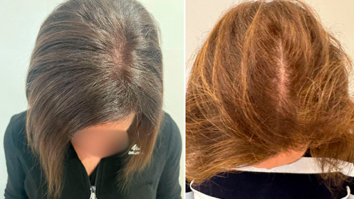 Sesión de Tratamiento regenerador capilar a mitad de precio